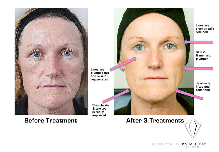 Frozen Facial