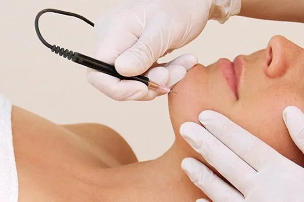 Electrolysis — Specialised Treatments, Natural Balance Hinckley