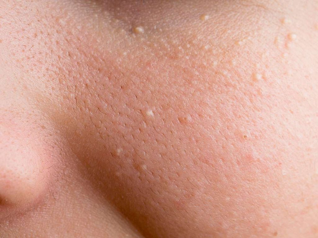 Milia Removal