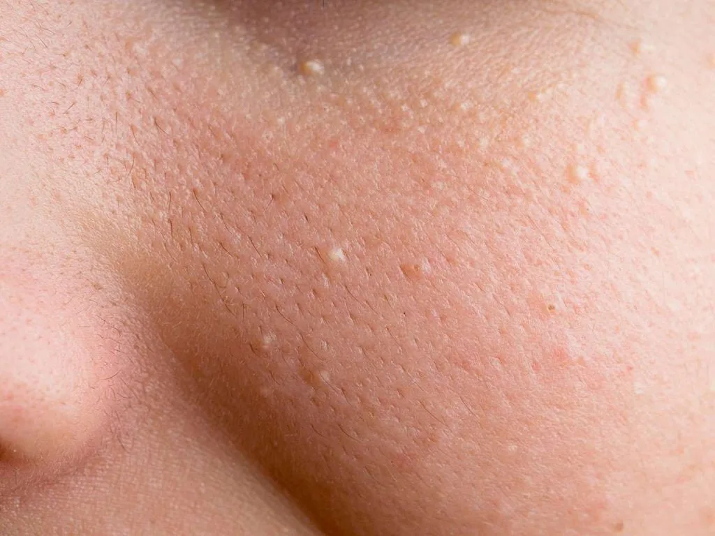 Milia Removal — Specialised Treatments, Natural Balance Hinckley