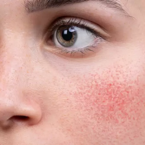 Red Vein Treatment